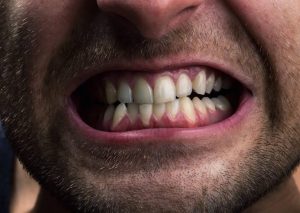 Folgen von Zähneknirschen (Bruxismus)